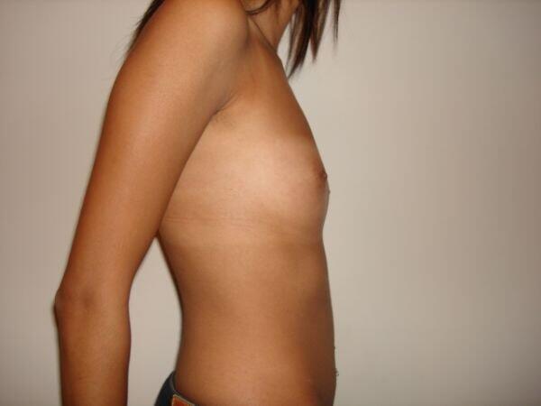 Breast Augmentation Before & After Image