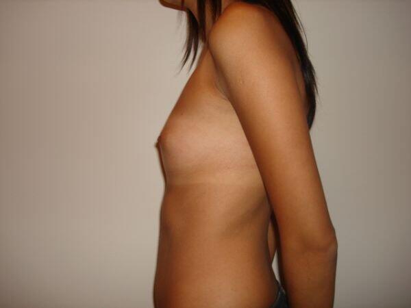 Breast Augmentation Before & After Image