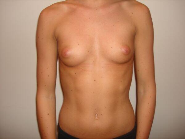 Breast Augmentation Before & After Image