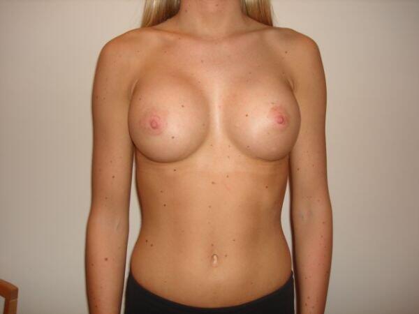 Breast Augmentation Before & After Image