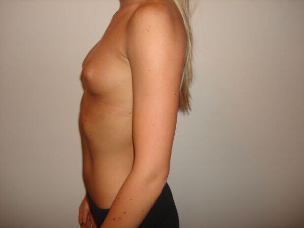 Breast Augmentation Before & After Image