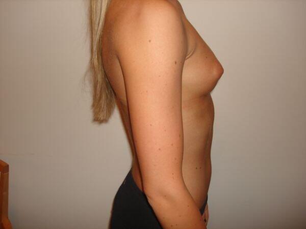 Breast Augmentation Before & After Image