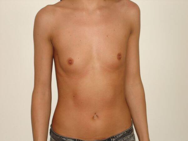 Breast Augmentation Before & After Image