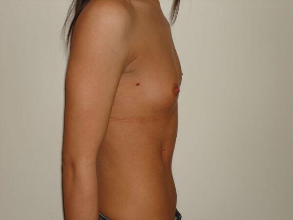 Breast Augmentation Before & After Image