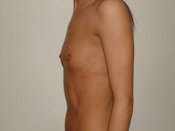 Breast Augmentation Before & After Image