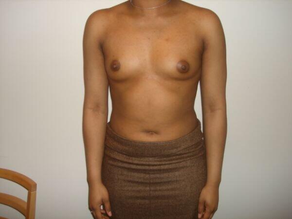 Breast Augmentation Before & After Image