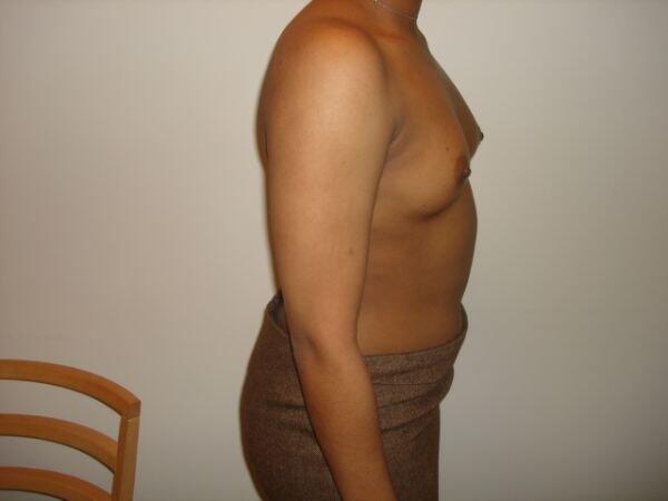 Breast Augmentation Before & After Image