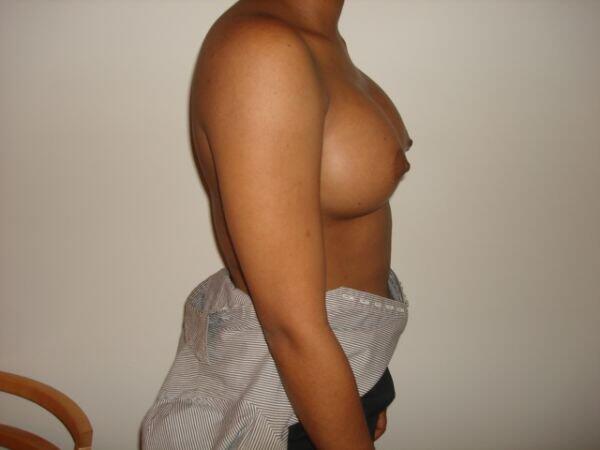 Breast Augmentation Before & After Image