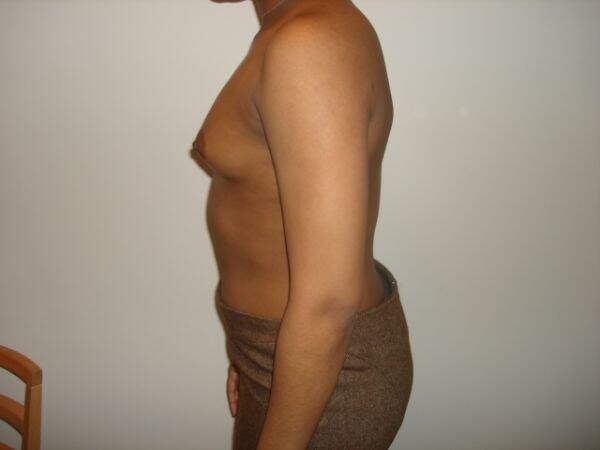 Breast Augmentation Before & After Image