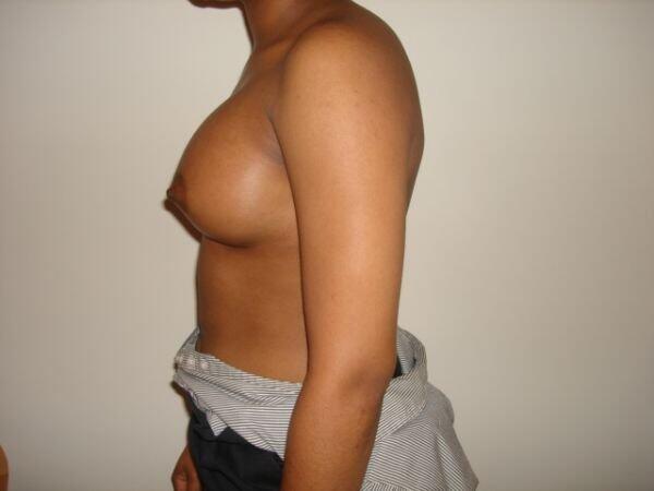 Breast Augmentation Before & After Image