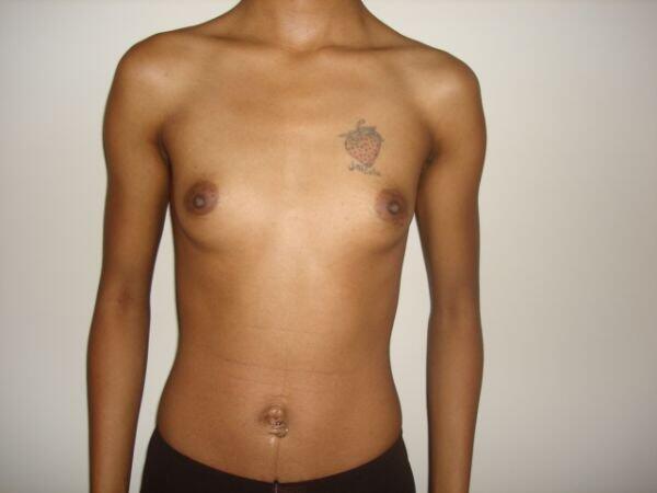 Breast Augmentation Before & After Image