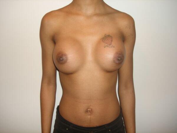 Breast Augmentation Before & After Image