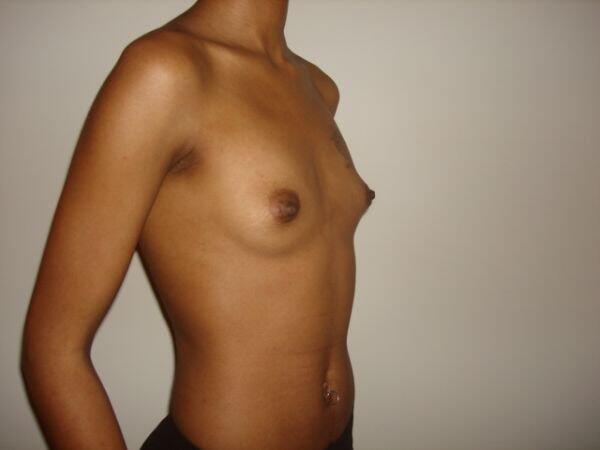 Breast Augmentation Before & After Image