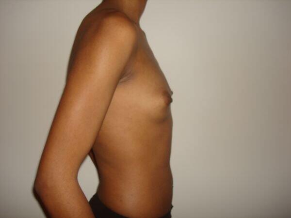 Breast Augmentation Before & After Image