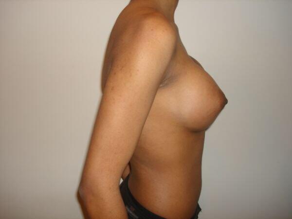 Breast Augmentation Before & After Image