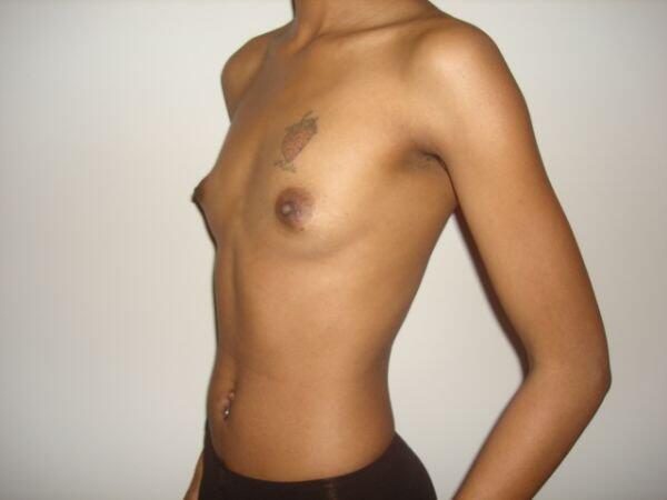 Breast Augmentation Before & After Image