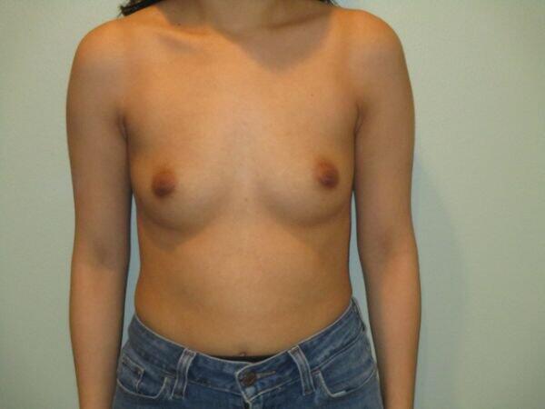 Breast Augmentation Before & After Image