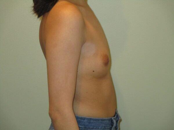 Breast Augmentation Before & After Image