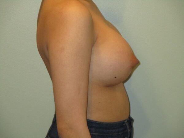 Breast Augmentation Before & After Image