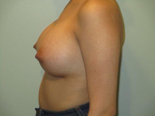 Breast Augmentation Before & After Image