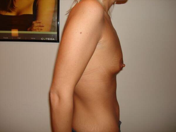 Breast Augmentation Before & After Image