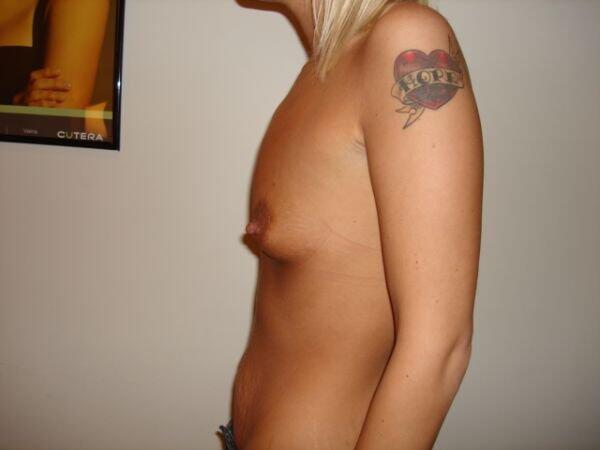 Breast Augmentation Before & After Image