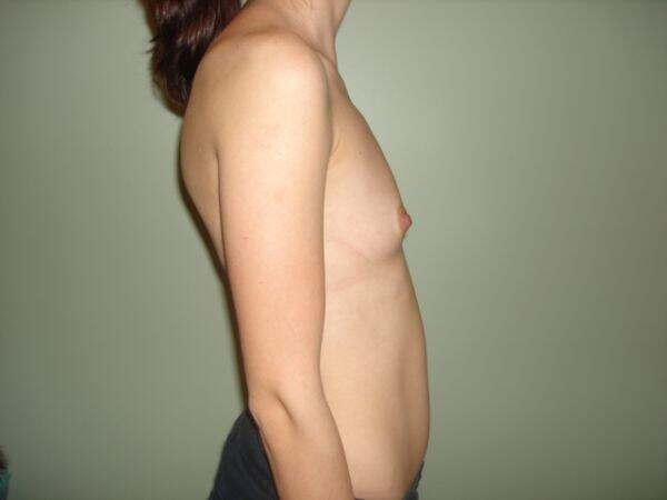 Breast Augmentation Before & After Image