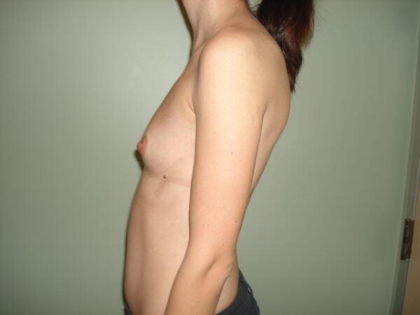 Breast Augmentation Before & After Image