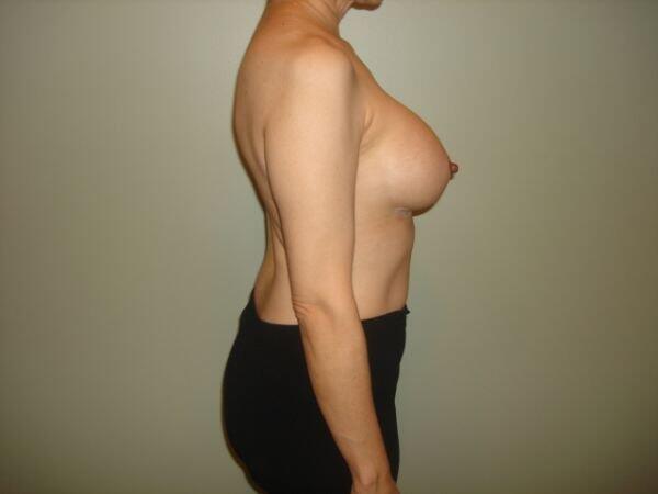 Breast Augmentation Before & After Image