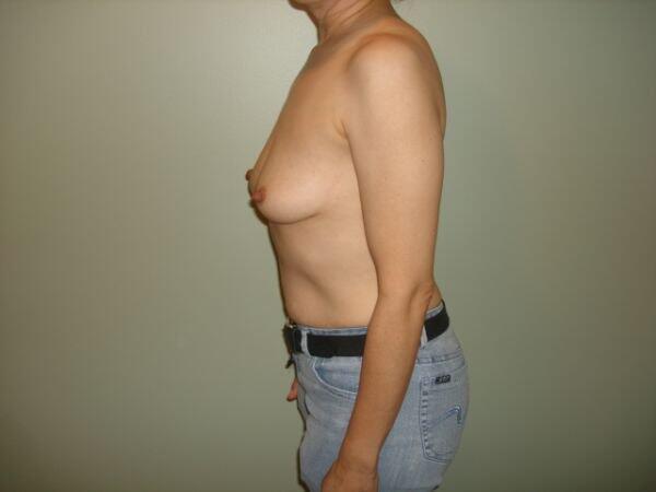 Breast Augmentation Before & After Image