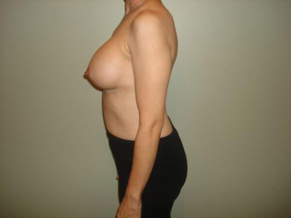 Breast Augmentation Before & After Image