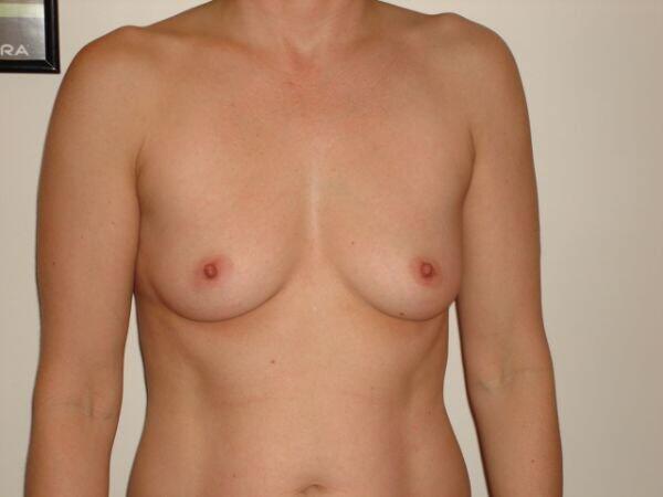 Breast Augmentation Before & After Image