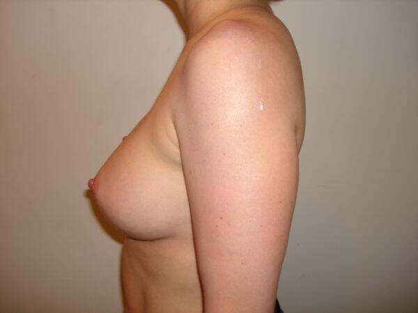 Breast Augmentation Before & After Image