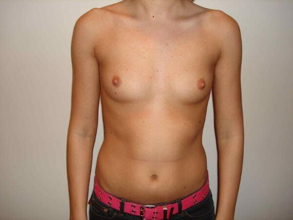 Breast Augmentation Before & After Image