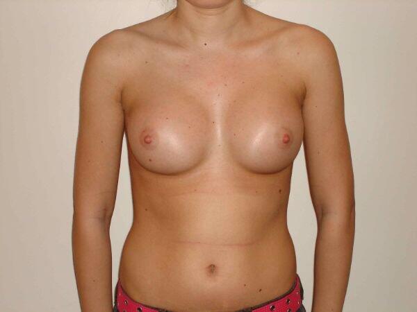 Breast Augmentation Before & After Image