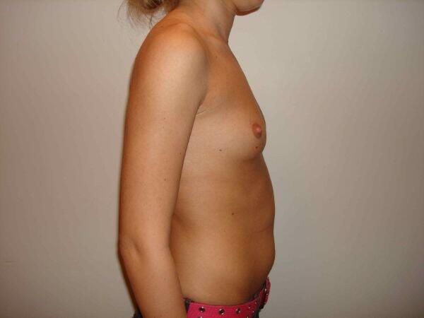 Breast Augmentation Before & After Image