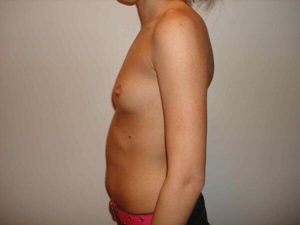 Breast Augmentation Before & After Image