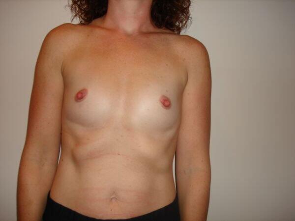 Breast Augmentation Before & After Image