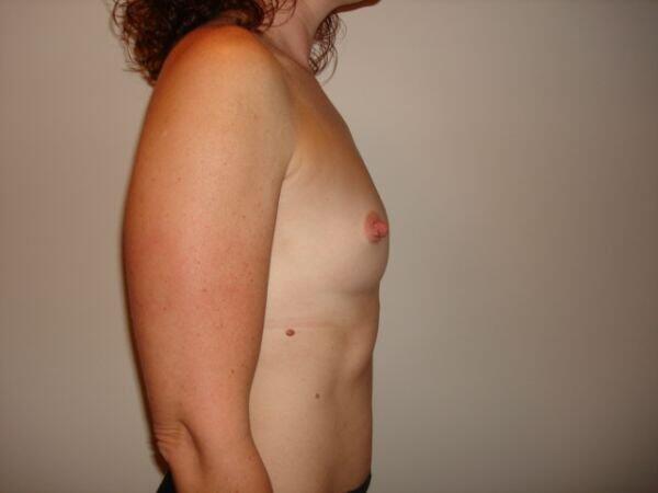 Breast Augmentation Before & After Image