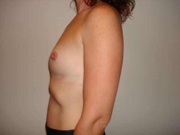 Breast Augmentation Before & After Image