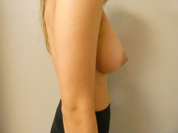 Breast Augmentation Before & After Image