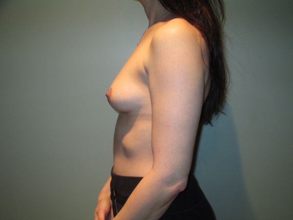 Breast Augmentation Before & After Image