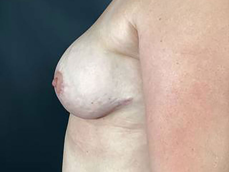 Breast Implant Revision with Lift Before & After Image