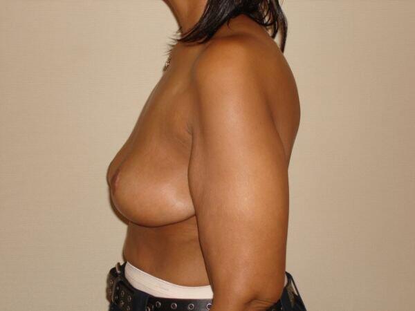 Breast Lift  Before & After Image