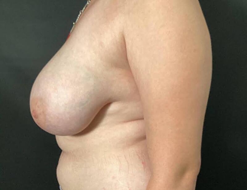 Breast Reduction Before & After Image