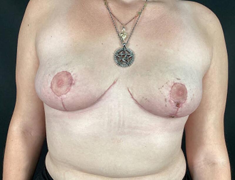 Breast Reduction Before & After Image