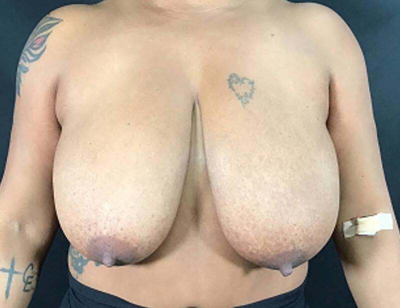 Breast Reduction Before & After Image