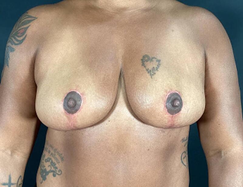 Breast Reduction Before & After Image