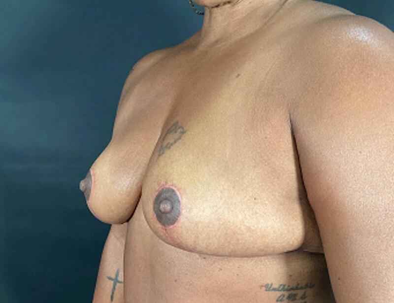 Breast Reduction Before & After Image