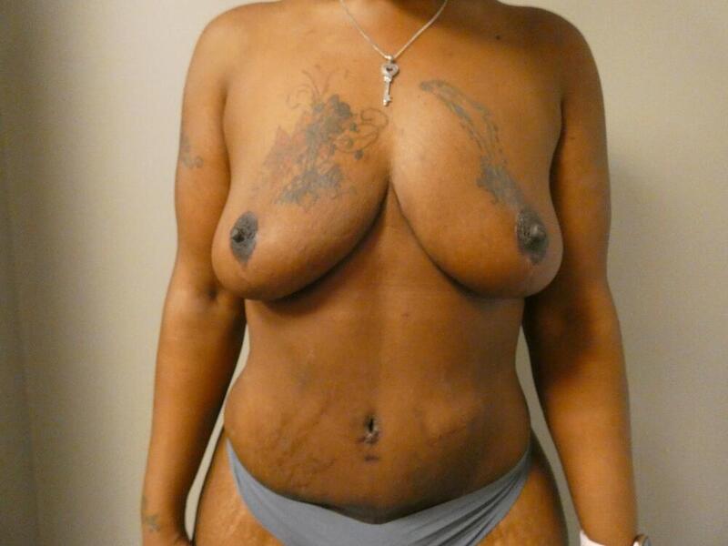 Breast Reduction Before & After Image